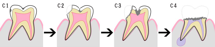 虫歯の段階