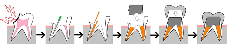 神経をとってかぶせが入るまでの流れ