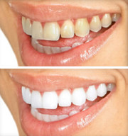 ホワイトニング